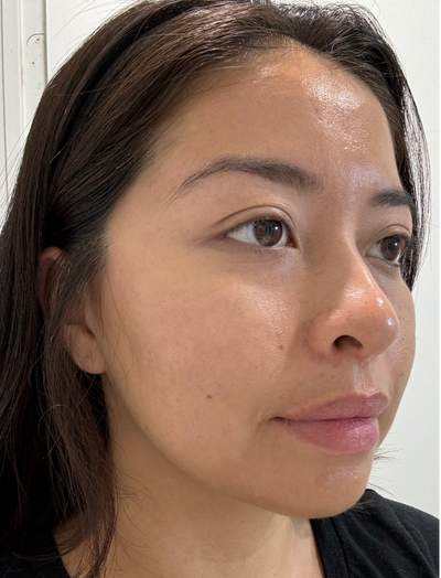 Side view after image of woman with smaller pores after 6 weeks of usage