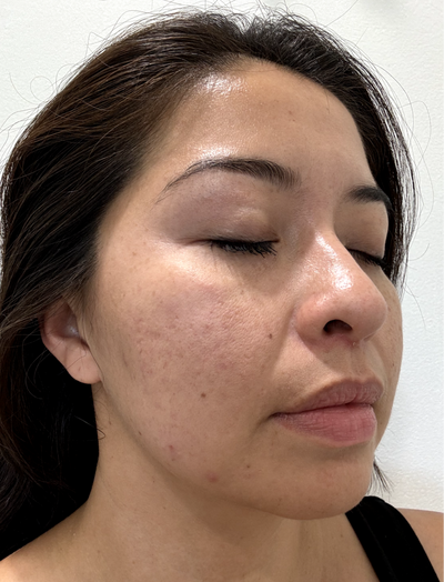 Side view before image of woman with visible facial pores