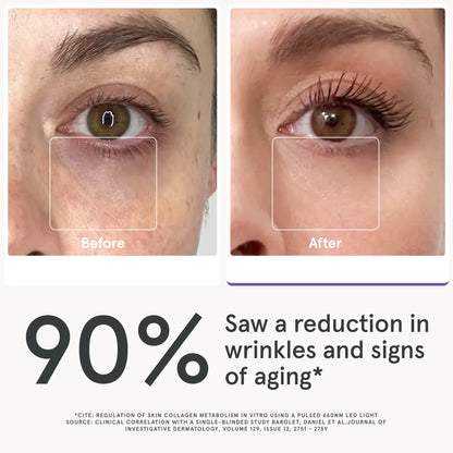 Before and after image after using the LED eye mask. 90% saw a reduction in wrinkles and signs of aging.