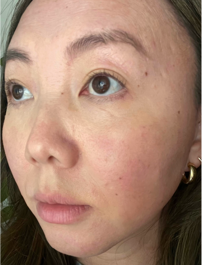Side view after image of woman with lesser facial redness and inflammation after 12 weeks of usage
