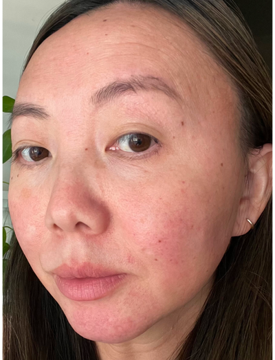 Side view before image of woman with visible facial redness and inflammation