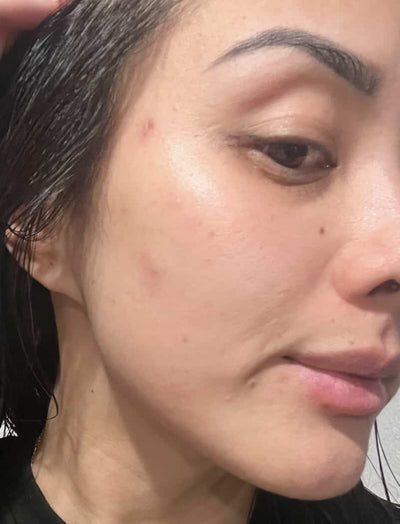 After image of close-up of a person's face with healed Acne.