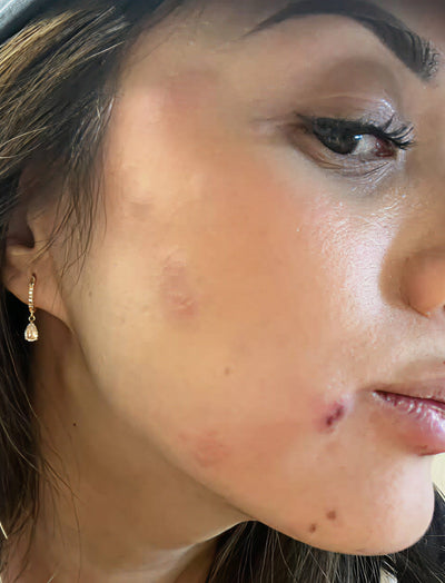 Before image of close-up of a person's face with visible Acne.