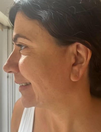 Side view before image of woman with visible wrinkles around the eyes and jowls